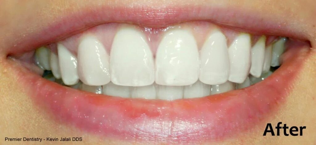 Patient Smile Case 1 after treatment