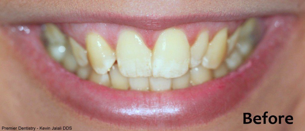 Patient Smile Case 1 before treatment