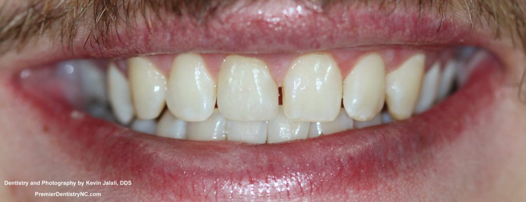 Patient Smile Case 2 after treatment