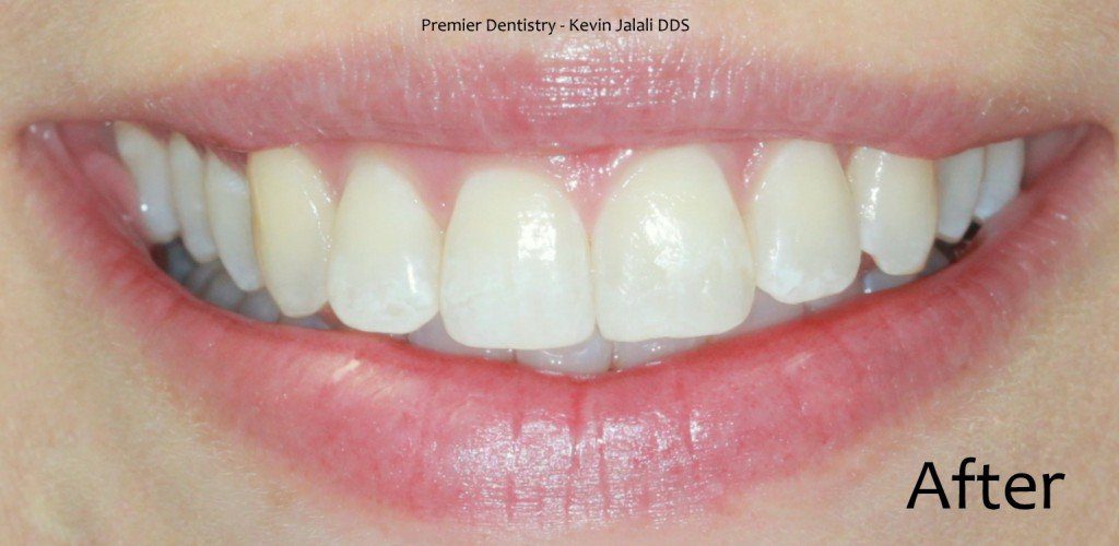 Patient Smile Case 3 after treatment