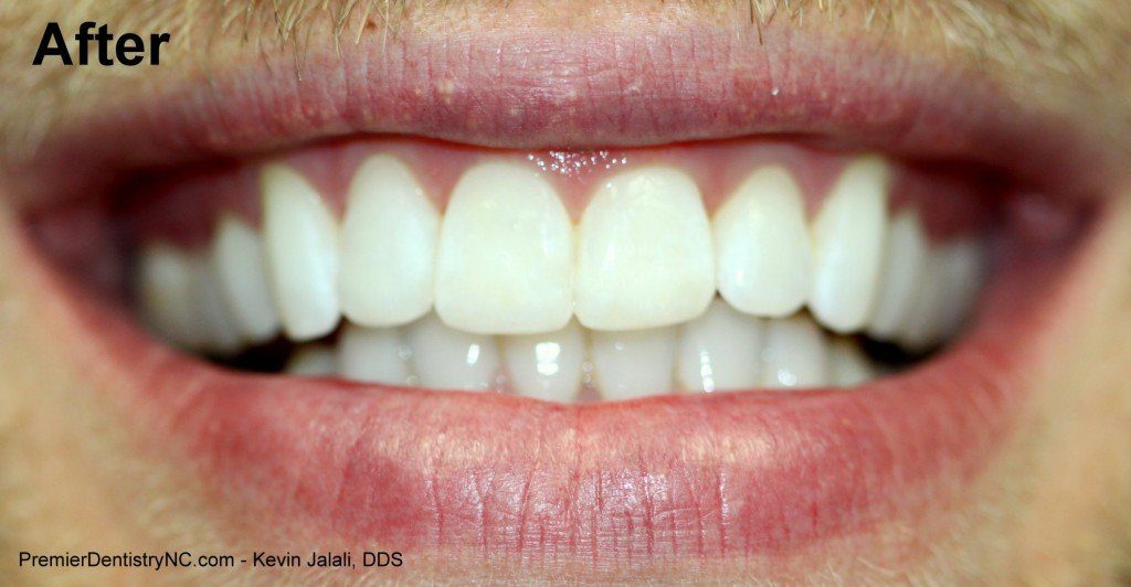 Patient Smile Case 4 after treatment