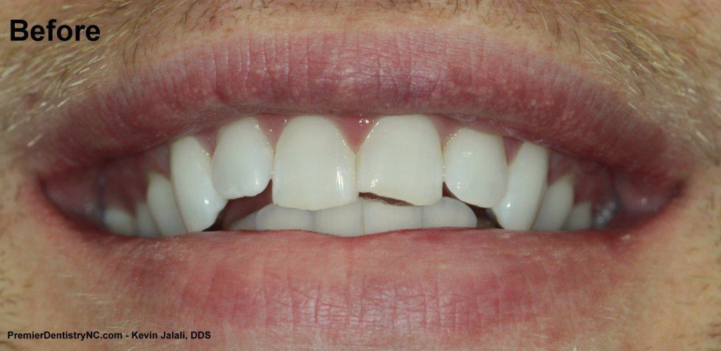 Patient Smile Case 4 before treatment