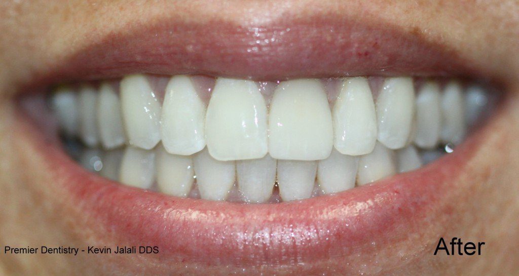 Patient Smile Case 5 after treatment