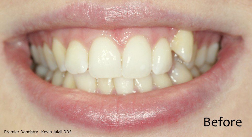 Patient Smile Case 6 before treatment